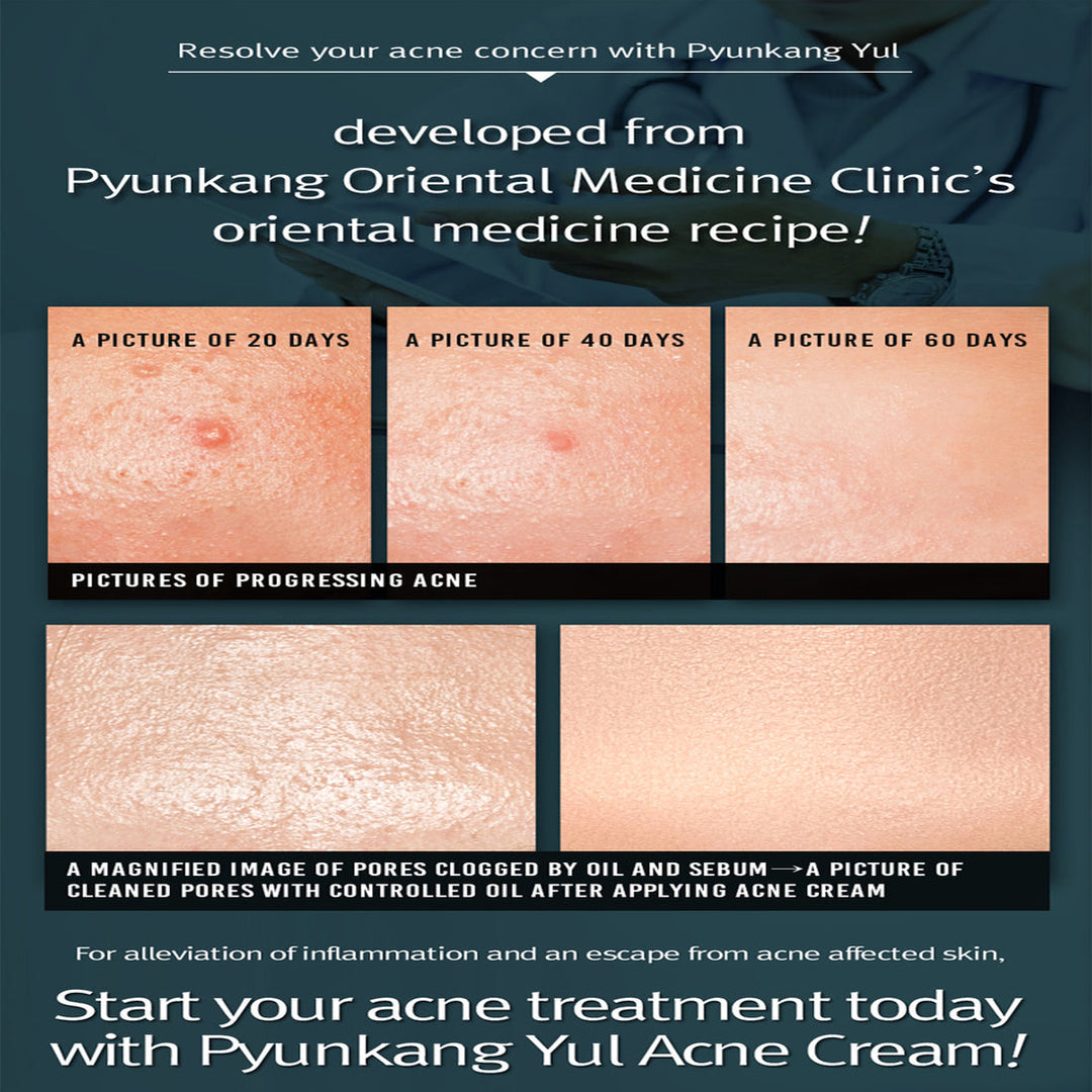 Pyunkang Yul Acne Cream  1.7 Fl. Oz,50ml