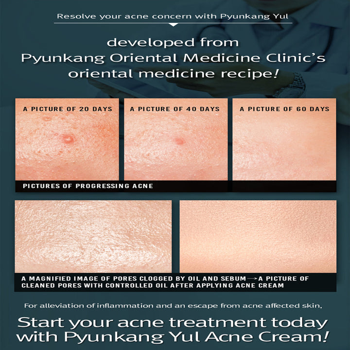 Pyunkang Yul Acne Cream  1.7 Fl. Oz,50ml